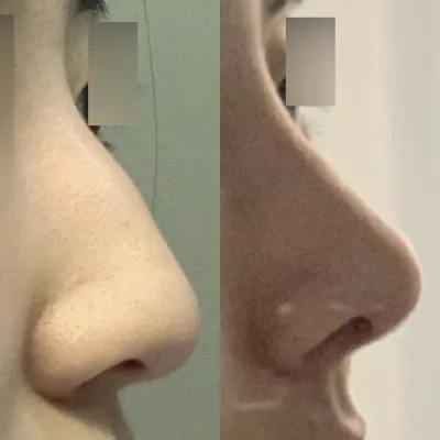 做了鷹鈎鼻手術ㅎㅎ