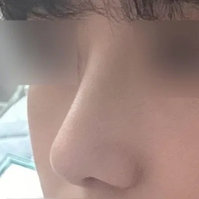 即使是第一次做隆鼻手術，也非常非常滿意，滿意度高達3728299393829%