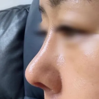 一直很苦惱鼻尖塌陷，現在有了鼻尖真是太好了^^