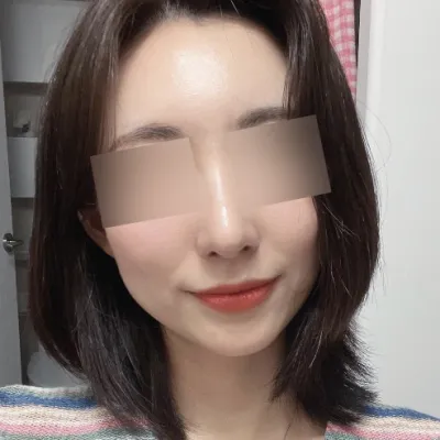 做了鼻子+額頭自體脂肪移植!!