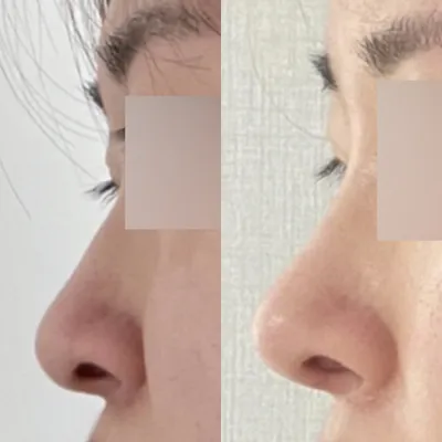 終於做了我長久以來的鼻子整形手術~
