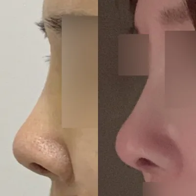 5年前突然做了隆鼻手術:-)))