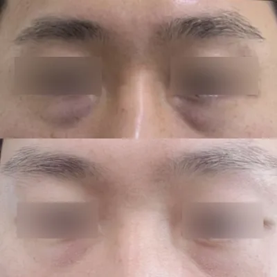 眼下脂肪重新定位手術後 2 個月的評論 :)