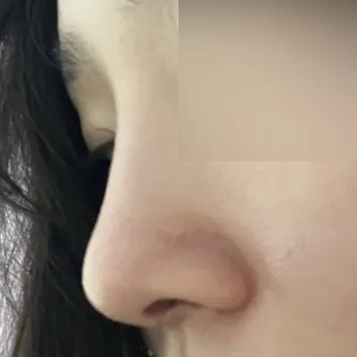 7月初在Weavers找沈正煥院長做了手術！