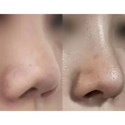 做完隆鼻手術才一個多月！