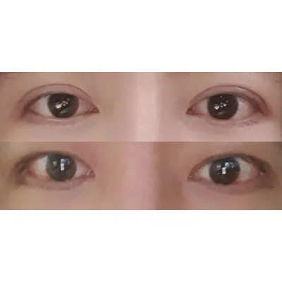 男性雙眼皮縮小重修手術 + 開眼頭手術後 10 天