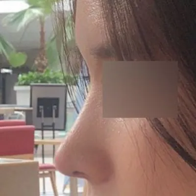 做了原本扁平的鷹鉤鼻手術