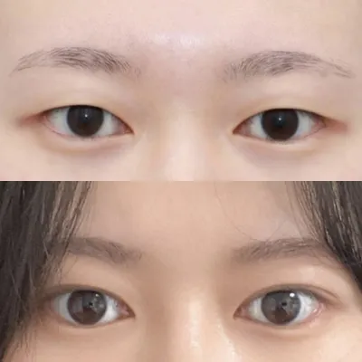 手術後3個月的後記