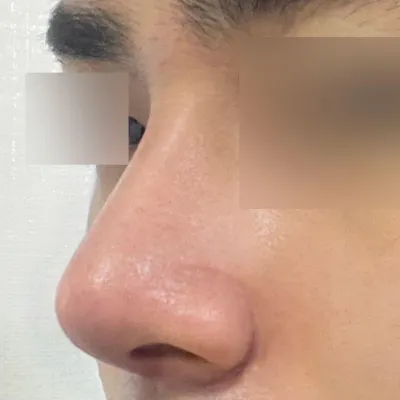 在韋伯斯整形外科做完手術已經兩週了。